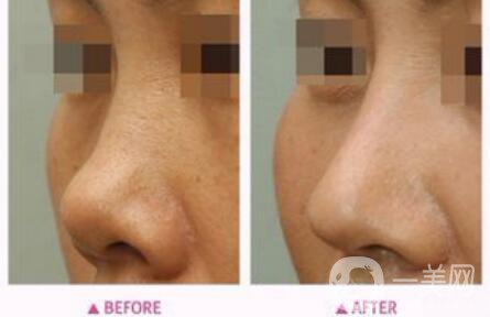 朝天鼻矯正多少錢