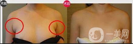 副乳祛除價格,副乳祛除術(shù)后護(hù)理