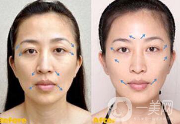 熱瑪吉副作用有哪些 如何避免副作用