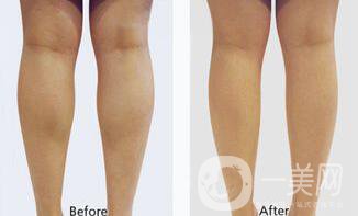 光纖溶脂瘦小腿有哪些優(yōu)勢