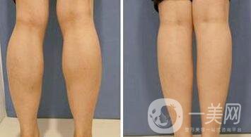 光纖溶脂瘦小腿有哪些優(yōu)勢