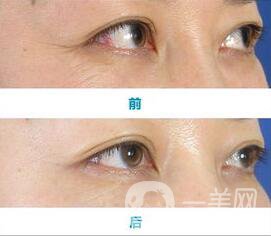 玻尿酸去眉間紋禁忌癥,玻尿酸去眉間紋注意事項