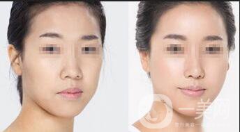 玻尿酸面部填充維持多久,玻尿酸面部填充價格