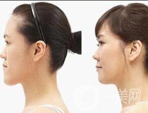 上海地包天矯正多少錢(qián),地包天矯正注意事項(xiàng)