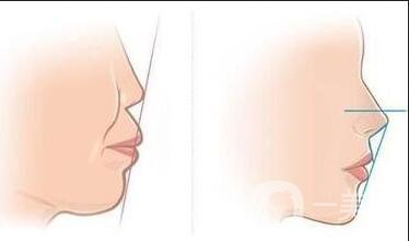 上海正頜手術(shù)多少錢,正頜手術(shù)術(shù)后護(hù)理