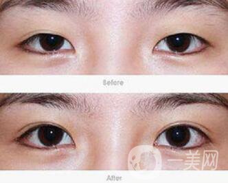 韓式開眼角哪*果好?韓式開眼角醫(yī)院信息介紹