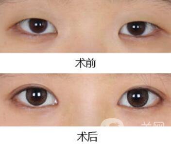 韓式開眼角哪*果好?韓式開眼角醫(yī)院信息介紹