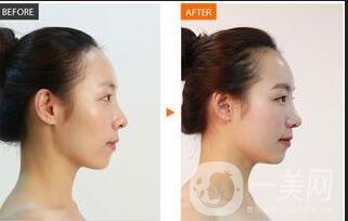 上海太陽穴填充多少錢,太陽穴填充注意事項