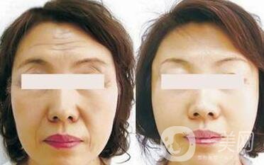 電波拉皮*果怎么樣呢？?jī)r(jià)格高嗎