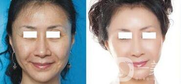 電波拉皮*果怎么樣呢？?jī)r(jià)格高嗎