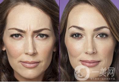 玻尿酸去眉間紋術后護理工作主要有些什么？