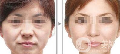 電波拉皮*果怎么樣呢？?jī)r(jià)格高嗎