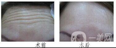 廣東祛抬頭紋多少錢,祛抬頭紋注意事項(xiàng)