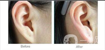 廣東自體脂肪豐耳垂多少錢,自體脂肪豐耳垂注意事項(xiàng)