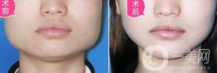 頜骨矯正術(shù)后護理方法有哪些