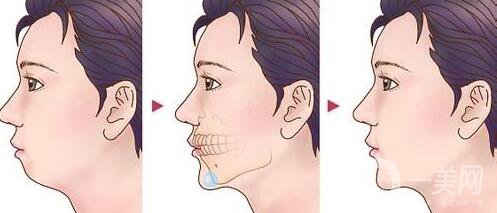 頜骨矯正術(shù)后護理方法有哪些