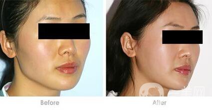 頜骨矯正術(shù)后護理方法有哪些