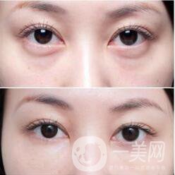 上海用脂肪填淚溝要多少錢