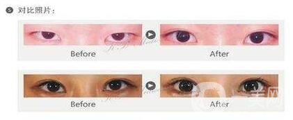 開眼角手術要花多少錢 價格貴不貴