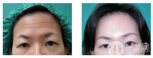 *去抬頭紋注意事項 術后要怎么護理