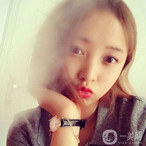 玻尿酸去魚尾紋價格 去魚尾紋費(fèi)用多少錢