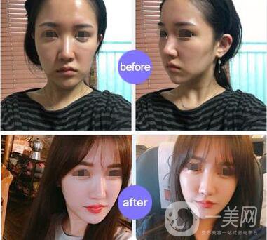 上海*價(jià)格 面部提升要多少錢