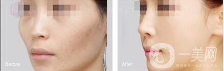 上海自體脂肪填充面部多少錢,自體脂肪填充面部注意事項(xiàng)