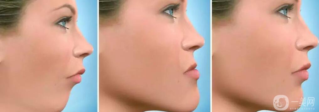 深圳天包地矯正多少錢,天包地矯正術(shù)后護(hù)理