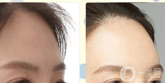 深圳豐額頭費(fèi)用,豐額頭方法