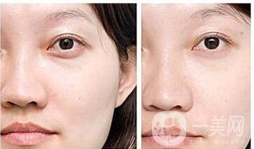 自體脂肪填充淚溝維持時間,自體脂肪填充淚溝價格