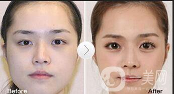 上海*臥蠶手術(shù)多少錢,*臥蠶手術(shù)注意事項(xiàng)