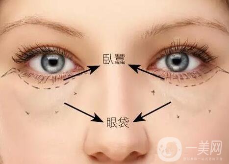 臥蠶整形,深圳臥蠶整形價(jià)格