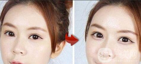 臥蠶整形,深圳臥蠶整形價(jià)格