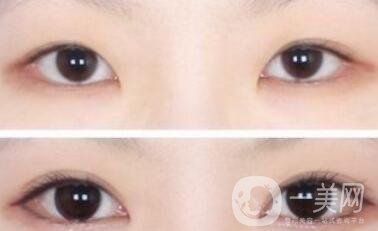 三點(diǎn)定位割雙眼皮多久恢復(fù)