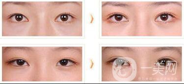 三點(diǎn)定位割雙眼皮多久恢復(fù)