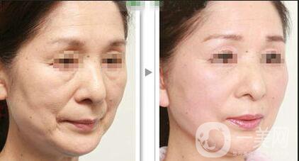 熱瑪吉緊膚價(jià)格