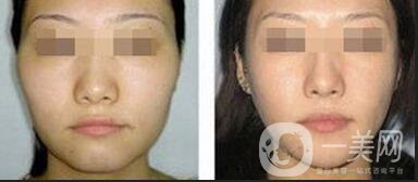 太陽穴自體脂肪填充,太陽穴自體脂肪填充多少錢,北京太陽穴自體脂肪填充多少錢