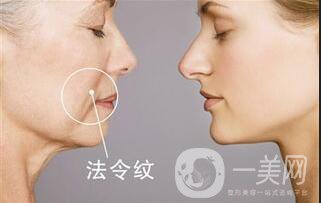 北京*去法令紋多少錢,*去法令紋多少錢,*去法令紋