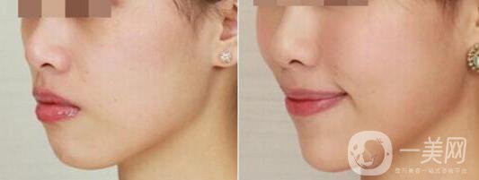 深圳打蘋(píng)果肌多少錢(qián),豐蘋(píng)果肌