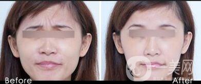 玻尿酸去眉間紋注意事項(xiàng),玻尿酸去眉間紋