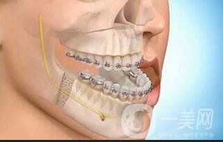 深圳牙齒地包天矯正價格,地包天矯正