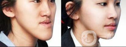 深圳牙齒地包天矯正價格,地包天矯正