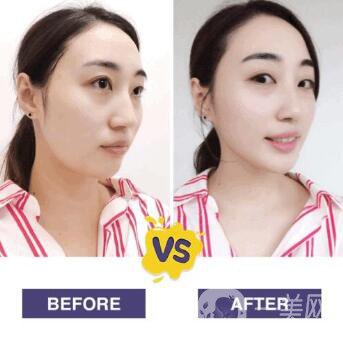 溶脂減肥的危害主要有哪些？詳細(xì)介紹