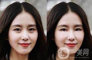 自體脂肪豐臥蠶術(shù)后護(hù)理主要有些什么注意事項