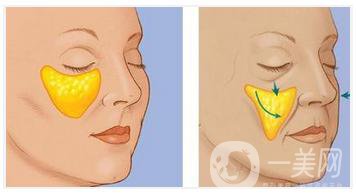 上海自體脂肪豐蘋果肌手術做一次多少錢