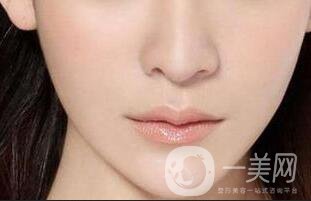 玻尿酸墊下巴,玻尿酸墊下巴注意事項(xiàng)