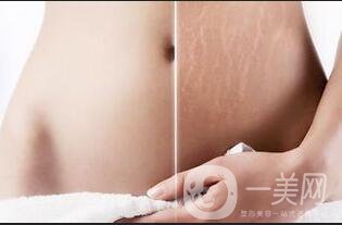 去妊娠紋方法