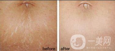 去妊娠紋注意事項(xiàng)