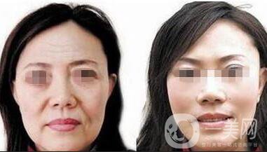 熱瑪吉緊膚除皺術(shù)后護(hù)理