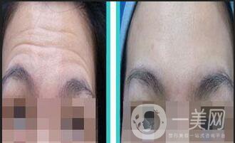 北京自體脂肪去抬頭紋價格